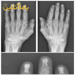 سی تی اسکن شکستگی